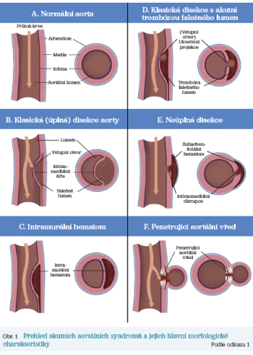 Obr. 1 Přehled akutních aortálních syndromů a jejich hlavní morfologické charakteristiky