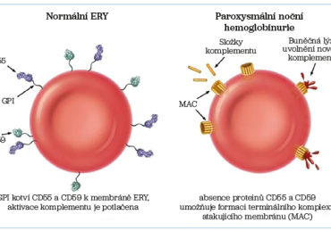 Obr. 1 Schéma vzniku hemolýzy u paroxysmální noční hemoglobinurie ERY – erytrocyty; GPI – glykosylfosfatidylinositol; MAC – komplex atakující membránu (membrane attack complex)