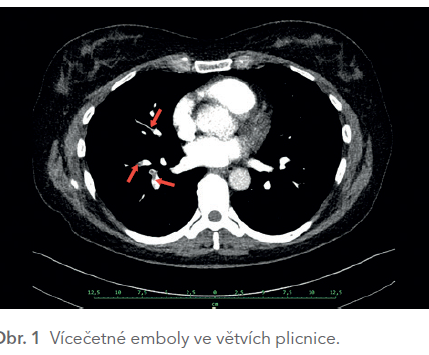 Obr. 1 Vícečetné emboly ve větvích plicnice.