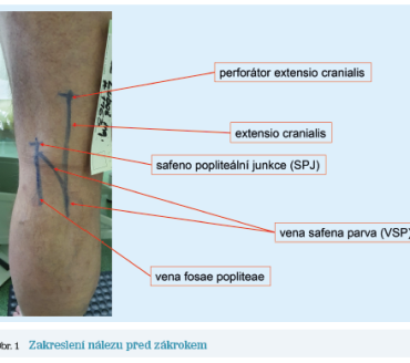 Obr. 1 Zakreslení nálezu před zákrokem