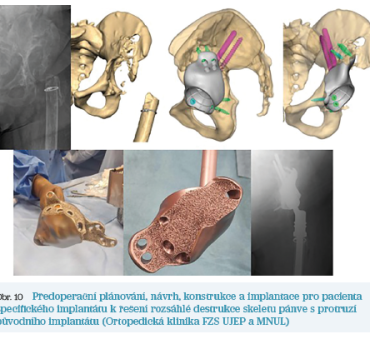 Obr. 10 Předoperační plánování, návrh, konstrukce a implantace pro pacienta specifického implantátu k řešení rozsáhlé destrukce skeletu pánve s protruzí původního implantátu