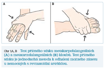 Obr 1A, B Test příčného stisku metakarpofalangeálních