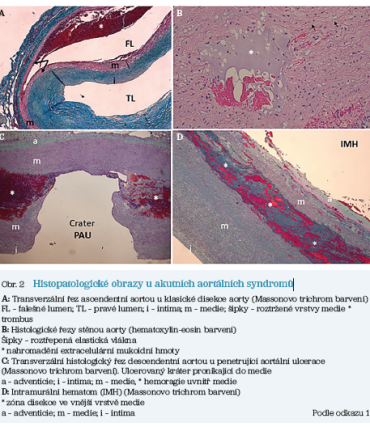 Obr. 2 Histopatologické obrazy u akutních aortálních syndromů