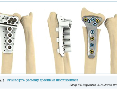 Obr. 2 Příklad pro pacienty specifické instrumentace