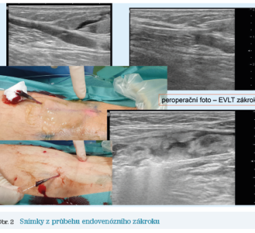 Obr. 2 Snímky z průběhu endovenózního zákroku