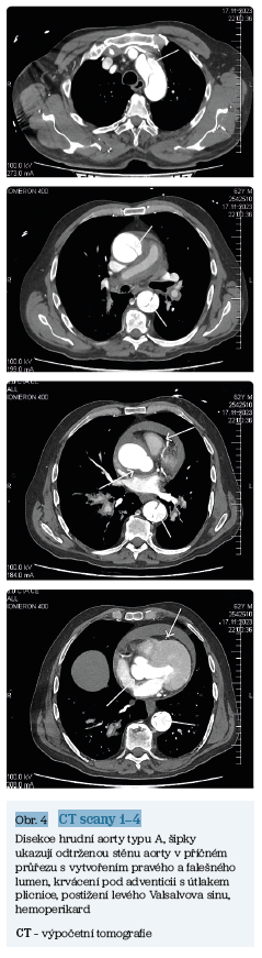 Obr. 4 CT scany 1–4