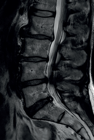 Obr. 4 Multietážová lumbální spinální stenóza s maximálním nálezem v etáži L4/5 s protruzí intervertebrálního disku a spondylartrózou zadních segmentů