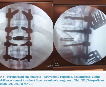 Obr. 4 Peroperační rtg kontrola