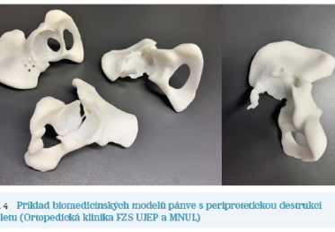 Obr. 4 Příklad biomedicínských modelů pánve s periprotetickou destrukcí skeletu