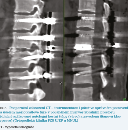 Obr. 5 Pooperační zobrazení CT