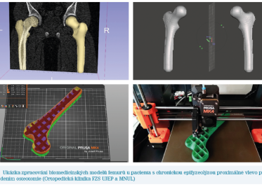 Obr. 5 Ukázka zpracování biomedicínských modelů femurů u pacienta s chronickou epifyzeolýzou proximálně vlevo před provedením osteotomie