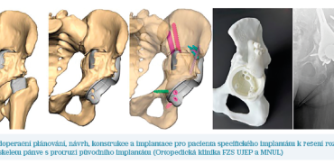 Obr. 8 Předoperační plánování, návrh, konstrukce a implantace pro pacienta specifického implantátu