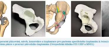 Obr. 9 Předoperační plánování, návrh, konstrukce a implantace pro pacienta specifického implantátu k řešení rozsáhlé destrukce skeletu pánve s protruzí původního implantátu