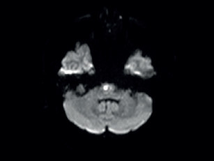 Obr. 3 Vyšetření pomocí MR mozku (DWI): čerstvá ischemie v pontu. MR – magnetická rezonance; DWI – difuzně vážené obrazy