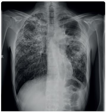 Obr. 2 Radiologický nález pacienta s MDR/RR TB. Rozsáhlý oboustranný radiologický nález, kaverny v obou plicních vrcholech (archiv autora) MDR/RR TB – multirezistentní, resp. rifampicin rezistentní tuberkulóza