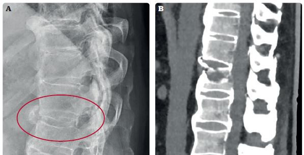 Obr. 3 Snímky extenční zlomeniny obratle L1 u pacienta s difuzní skeletální hyperostózou. Na rtg (A) jsou traumatické změny velmi diskrétní a snadno přehlédnutelné (radiologem nebylo popsáno žádné trauma). CT (B) stejného pacienta s jasně viditelnou lomnou linií v obratli – jedná se o velmi nestabilní poranění, které je nutno operovat.